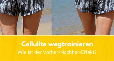 senfsalbe vorher-nachher|Fettabsaugung Cellulite: Wie ist der Vorher